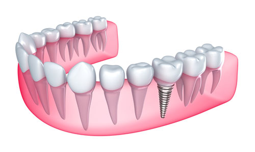 dental-implants-tempe-az