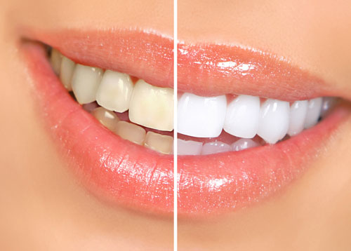 professional-teeth-whitening-tempe-az