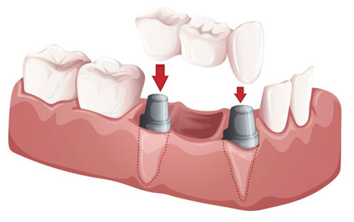 dental-bridge-tempe-az