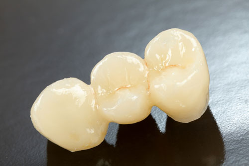 dental-crown-tempe-az