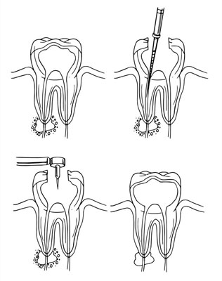 root-canal-tempe-az